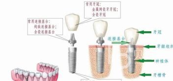 70歲的老人骨量不足還能做種植牙嗎？北京海德堡口腔怎么樣？