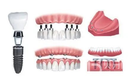 半口種植牙需要幾個種植體？北京牙管家口腔怎么樣？