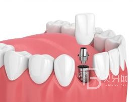 老年人適合種植牙么？北京薇琳口腔種植牙怎么樣？