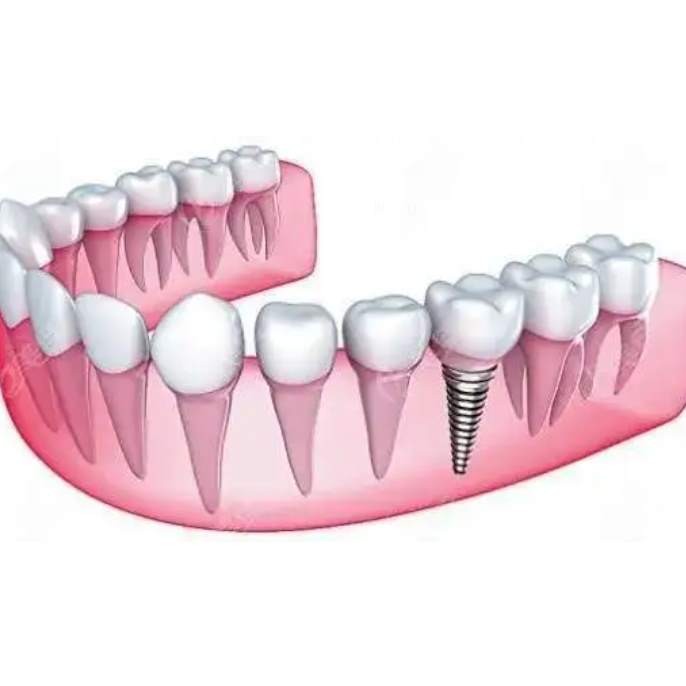 杭州種植一顆假牙多少錢！杭州聞喜淇杰口腔醫(yī)院(余杭古墩路口腔診所)種植牙價格表搶先看，國產(chǎn)拜阿蒙種植牙：2371元起/顆！