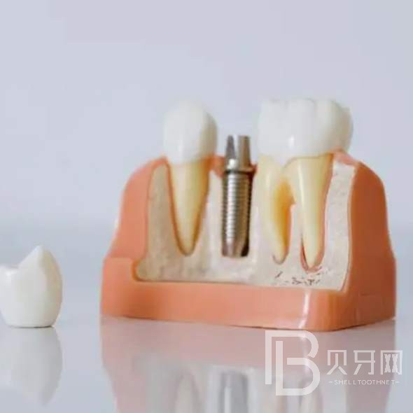 杭州種植一顆假牙多少錢！桐廬付現(xiàn)生口腔診所種植牙醫(yī)院排名TOP1，瑞典諾貝爾種植牙：5417元起/顆！