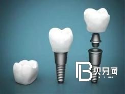 北京種植牙齒價(jià)格多少？含北京種植牙價(jià)格表！