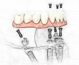 東莞好佰年口腔all on-4種植牙怎么樣？