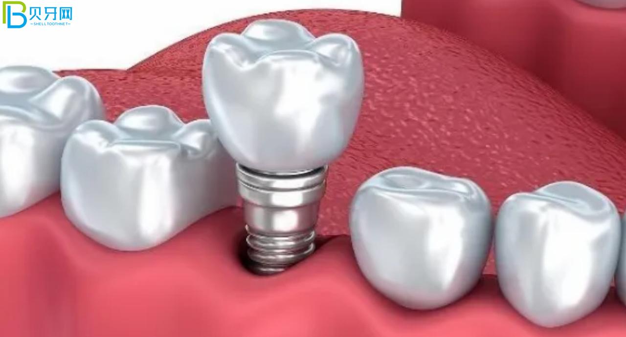 裝假牙怎么能少的了唯美口腔,聽(tīng)說(shuō)鑲牙3500元起?