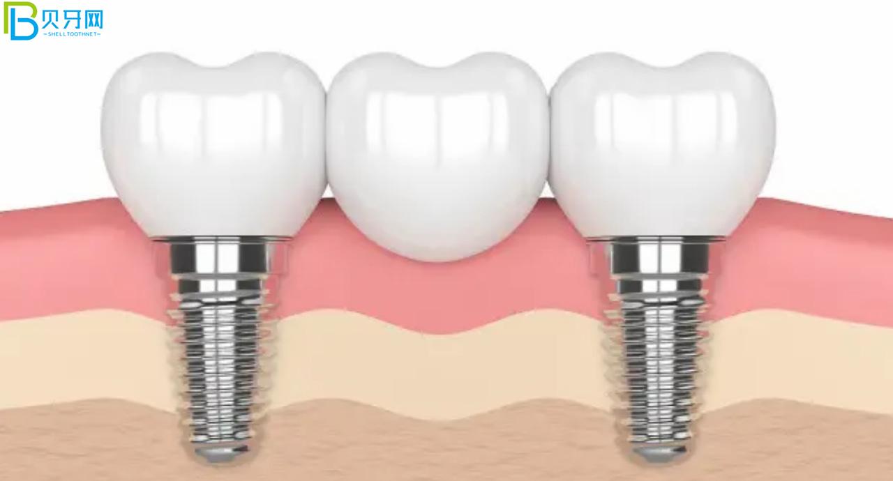 裝假牙怎么能少的了唯美口腔,聽(tīng)說(shuō)鑲牙3500元起?